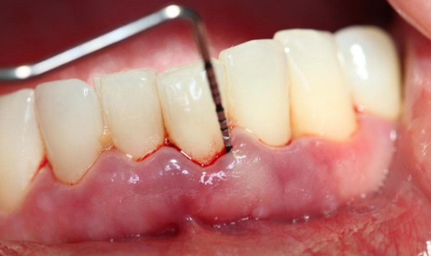 Cạo vôi răng không đúng cách có thể gây tổn thương nướu