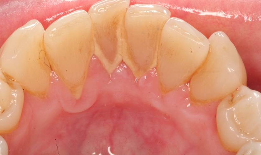 Vôi răng gây ra rất nhiều tác hại nghiêm trọng cho sức khỏe răng miệng