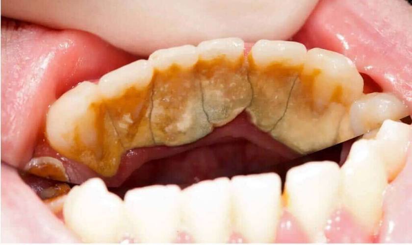 Cạo vôi răng nhiều có tốt không?