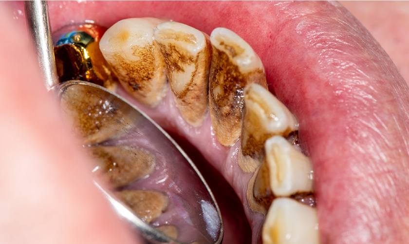 Vôi răng là nguyên nhân hàng đầu dẫn đến những bệnh lý răng miệng