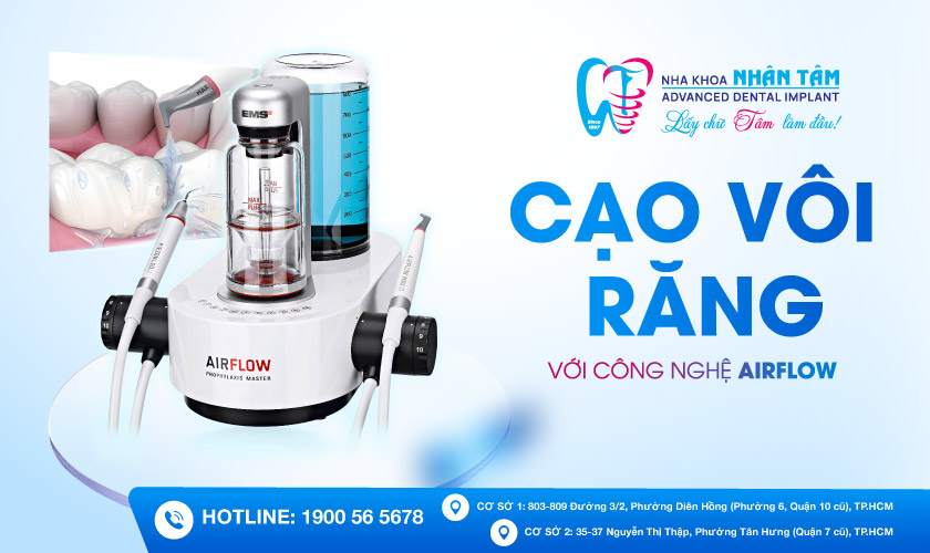 Cạo vôi răng với công nghệ Airflow