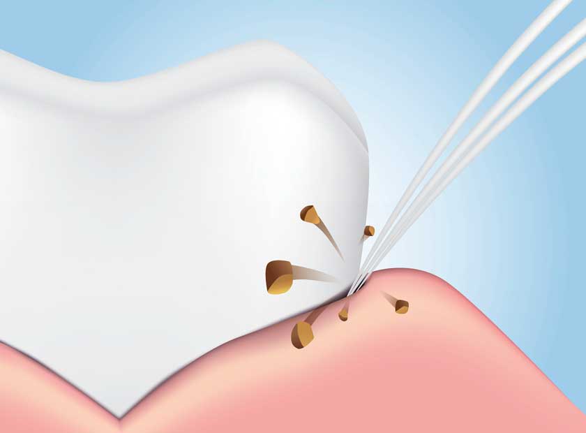 Cạo vôi răng là quá trình loại bỏ vôi răng bằng dụng cụ chuyên dụng tại nha khoa