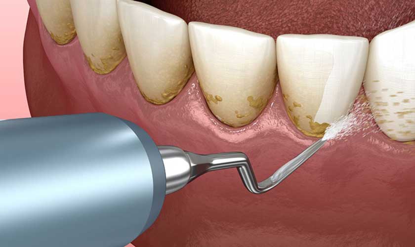 Cạo vôi răng giúp bảo vệ sức khỏe răng miệng và thẩm mỹ nụ cười