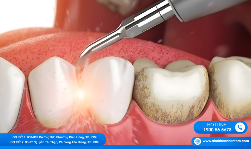 Đừng quên xin thông tin về công nghệ cạo vôi răng khi tư vấn với Bác sĩ nhé!