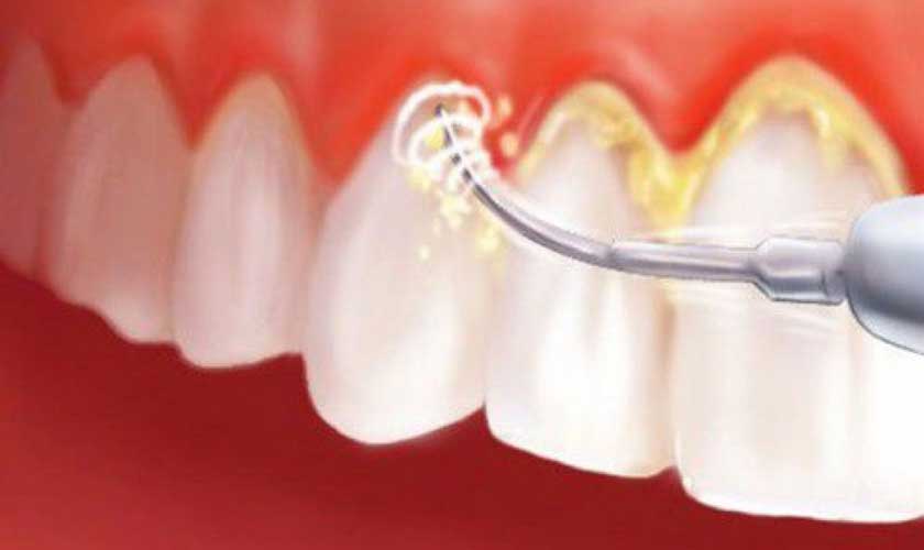 Máy cạo vôi răng sử dụng bước sóng siêu âm nhẹ nhàng loại bỏ vôi răng