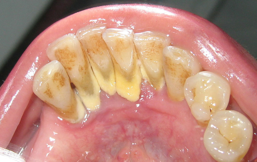 Vôi răng là nguyên nhân hàng đầu gây ra các bệnh lý răng miệng