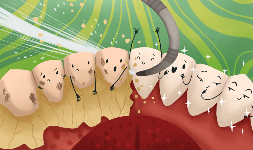 Quy trình cạo vôi răng được thực hiện như thế nào?