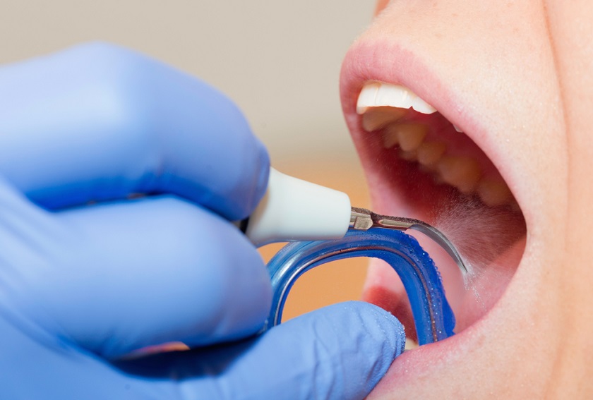 Cạo vôi răng bằng máy siêu âm Cạo vôi răng bằng máy siêu âm