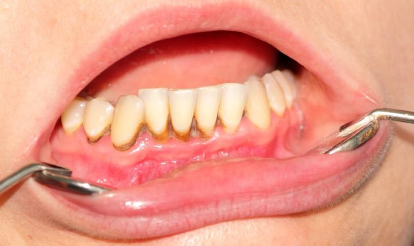 Vôi răng gây mất thẩm mỹ và gây hại cho sức khỏe răng miệng Vôi răng gây mất thẩm mỹ và gây hại cho sức khỏe răng miệng