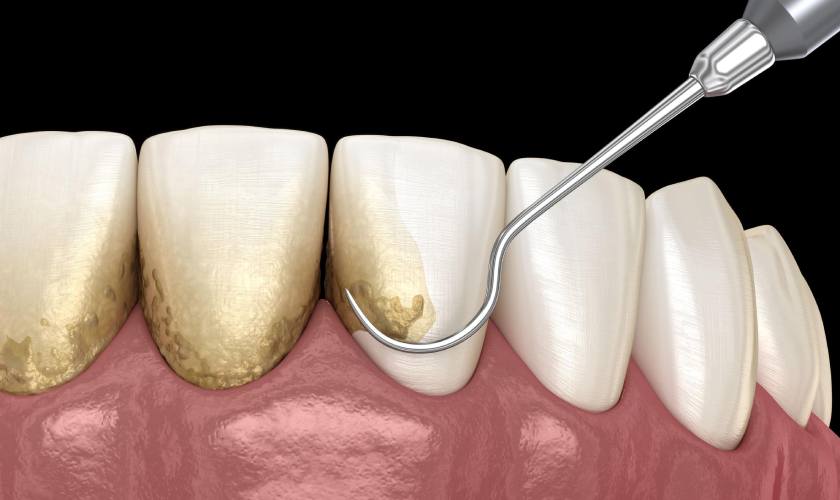 Cạo vôi răng bằng sóng siêu âm giúp loại bỏ vôi răng nhanh chóng, hiệu quả và an toàn Cạo vôi răng bằng sóng siêu âm giúp loại bỏ vôi răng nhanh chóng, hiệu quả và an toàn
