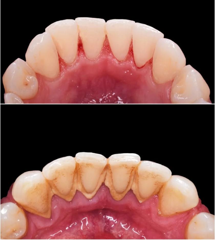Hình ảnh cạo vôi răng Hình ảnh cạo vôi răng