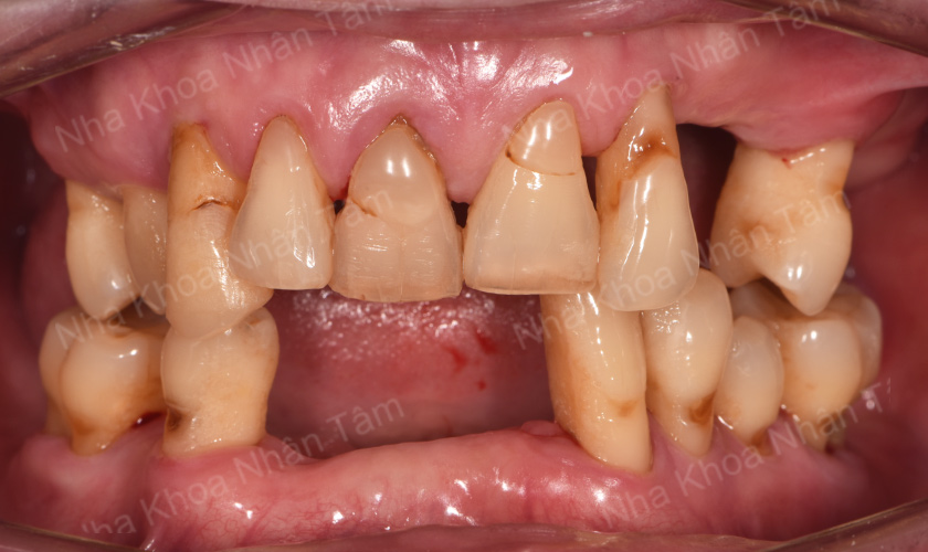 Viêm nướu nếu không điều trị sẽ tiến triển thành viêm nha chu và dẫn đến mất răng