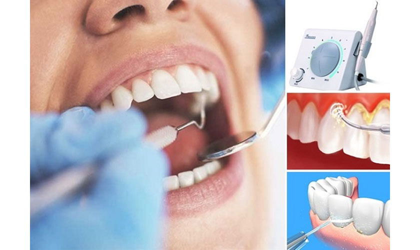 Cạo vôi răng bằng công nghệ siêu âm