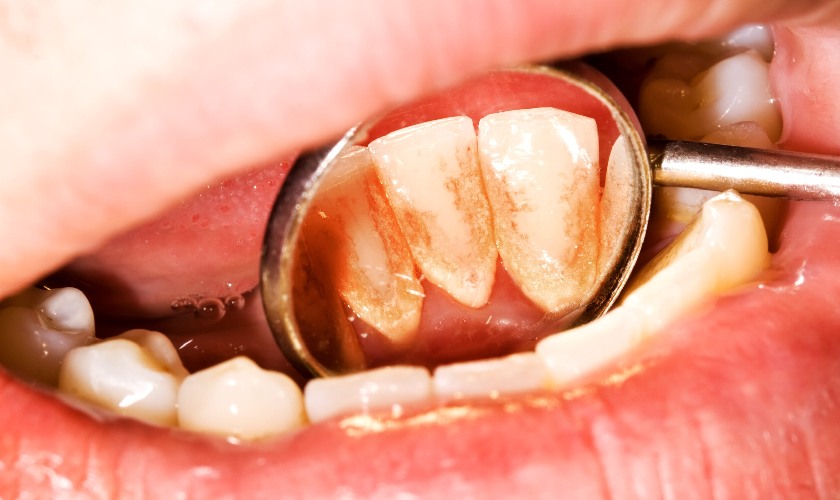 Vôi răng là những mảng bám cứng đầu bám trên răng