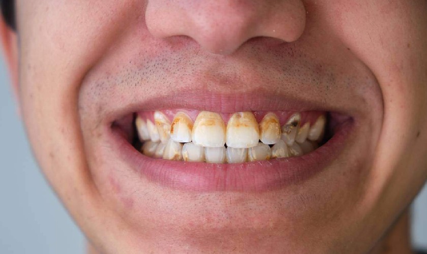 Vôi răng tự tróc là điều không hề dễ dàng