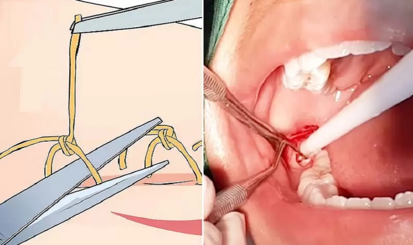 Cắt chỉ răng khôn là chỉ định bắt buộc nếu dùng chỉ khâu thông thường