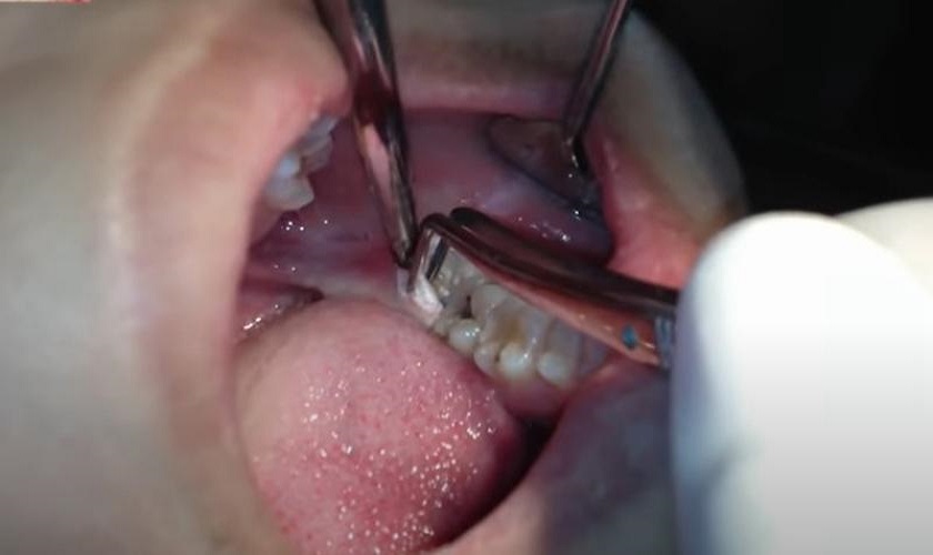 Cắt lợi trùm loại bỏ mô lợi phủ trên răng khôn