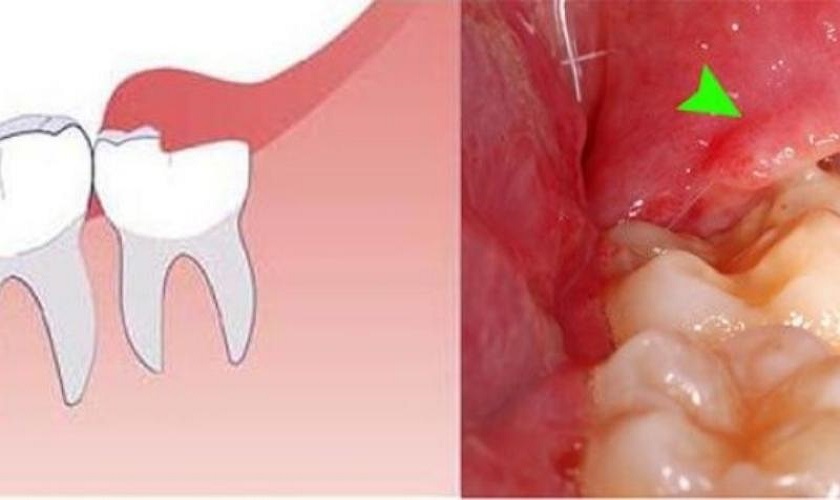 Viêm lợi trùm răng khôn có thể xảy ra nếu không được cắt bỏ kịp thời