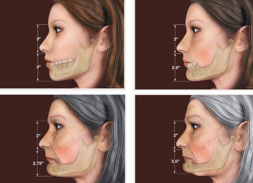 Lão hóa trước tuổi do mất răng toàn hàm