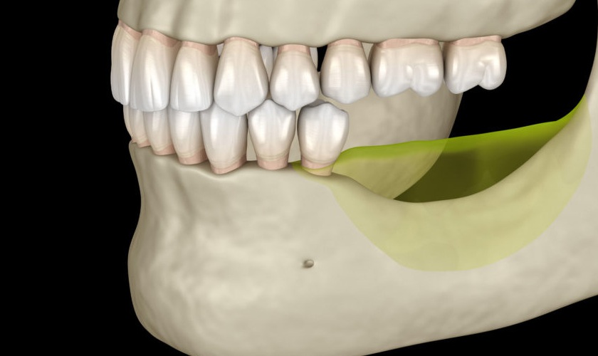 Tiêu xương hàm do mất răng lâu ngày