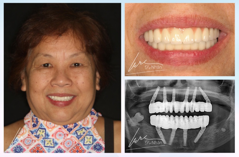 Sở hữu hàm răng khỏe đẹp với Implant All on X