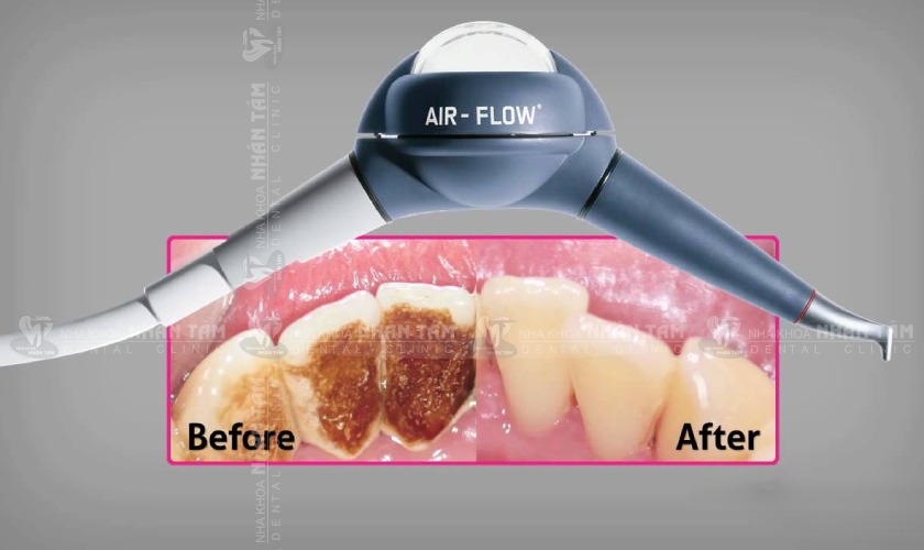 Airflow Prophylaxis loại bỏ mảng bám một cách nhẹ nhàng, không đau