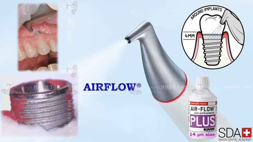 Công nghệ Airflow Prophylaxis là một phương pháp chăm sóc răng Implant hiệu quả