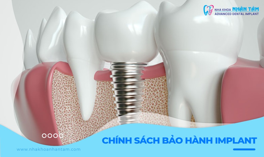 An tâm cấy ghép Implant với chính sách bảo hành lâu dài