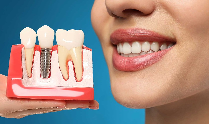 Chính sách bảo hành là yếu tố quyết định sự an tâm của khách hàng khi cấy ghép Implant Chính sách bảo hành là yếu tố quyết định sự an tâm của khách hàng khi cấy ghép Implant