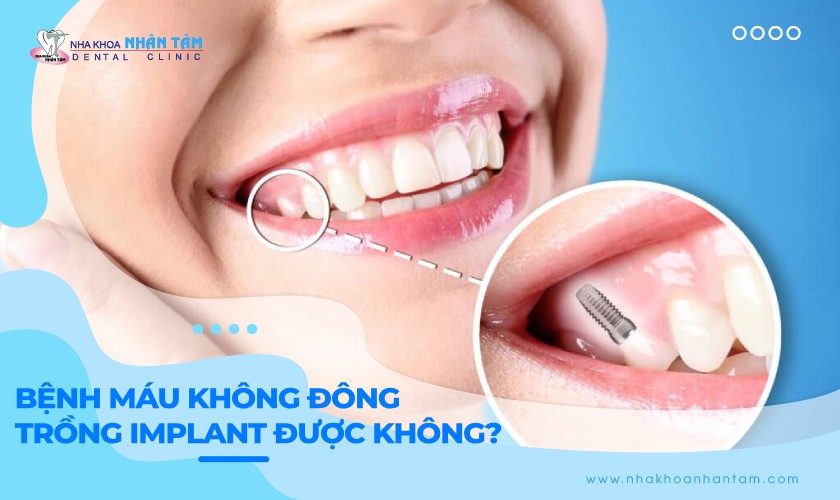 Bệnh máu không đông có trồng răng Implant được không?