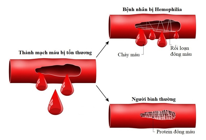 Máu không đông là một bệnh lý nguy hiểm