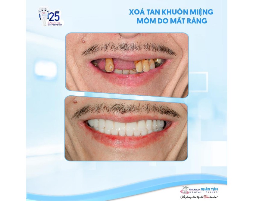 Implant cho hàm răng đều, đẹp