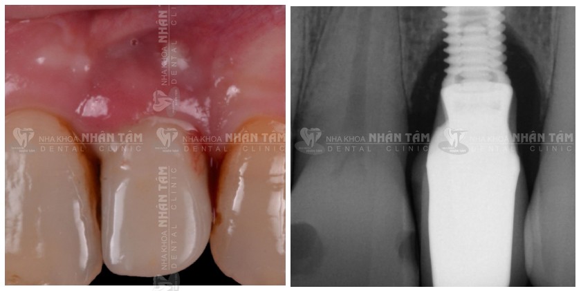 Tình trạng ban đầu: túi sâu & tiêu xương mức độ vừa Tình trạng ban đầu: túi sâu & tiêu xương mức độ vừa