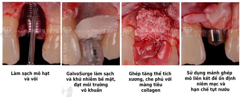 Các bước thực hiện phẫu thuật Các bước thực hiện phẫu thuật