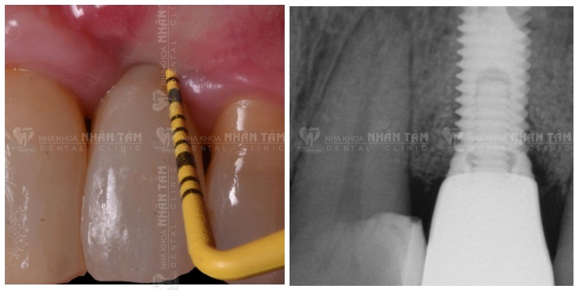 Theo dõi sau 20 tháng cho thấy tăng mức xương đáng kể và ổn định trên phim X-quang Theo dõi sau 20 tháng cho thấy tăng mức xương đáng kể và ổn định trên phim X-quang