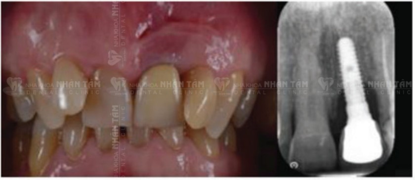 Tình trạng lâm sàng ban đầu và phim X-quang Tình trạng lâm sàng ban đầu và phim X-quang