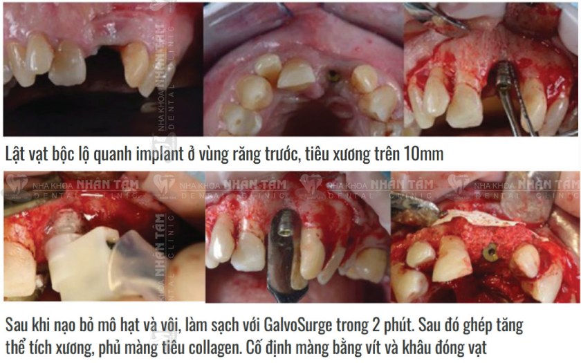 Các bước thực hiện phẫu thuật Các bước thực hiện phẫu thuật