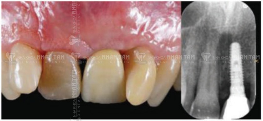 Theo dõi sau 1 năm Theo dõi sau 1 năm