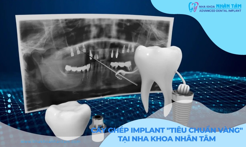 Cấy ghép Implant tiêu chuẩn vàng tại Nha khoa Nhân Tâm
