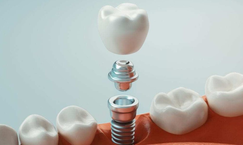Chi phí cấy ghép Implant khá cao