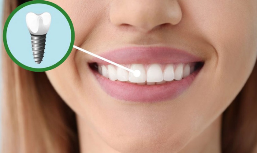 Implant là giải pháp phục hình răng được nhiều người lựa chọn Implant là giải pháp phục hình răng được nhiều người lựa chọn