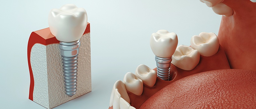 Chi phí trồng răng Implant sẽ tùy vào mỗi người Chi phí trồng răng Implant sẽ tùy vào mỗi người