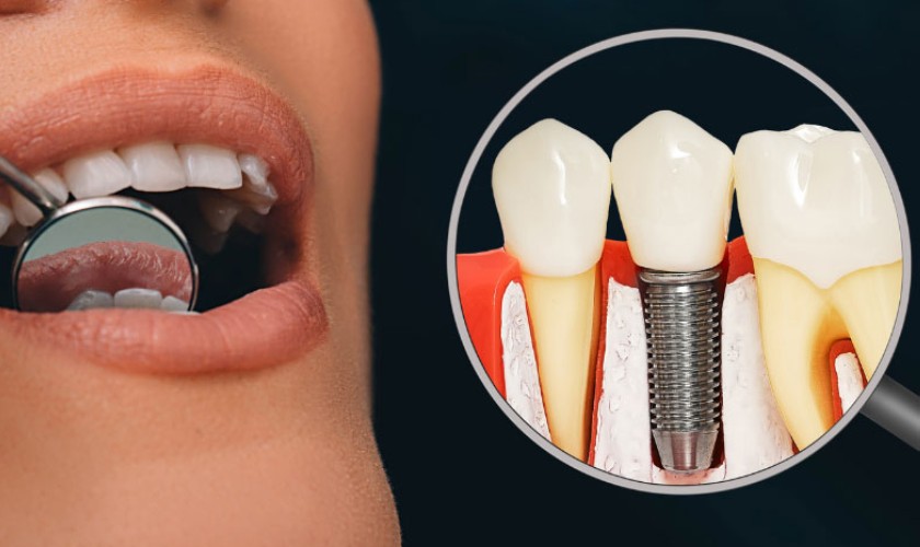 Trồng răng Implant là giải pháp phục hình răng tối ưu hiện nay
