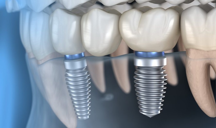 Mỗi loại Implant sẽ có chi phí khác nhau