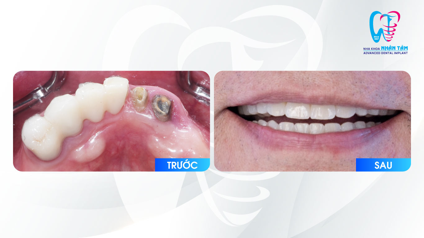 Tình trạng răng trước của khách hàng