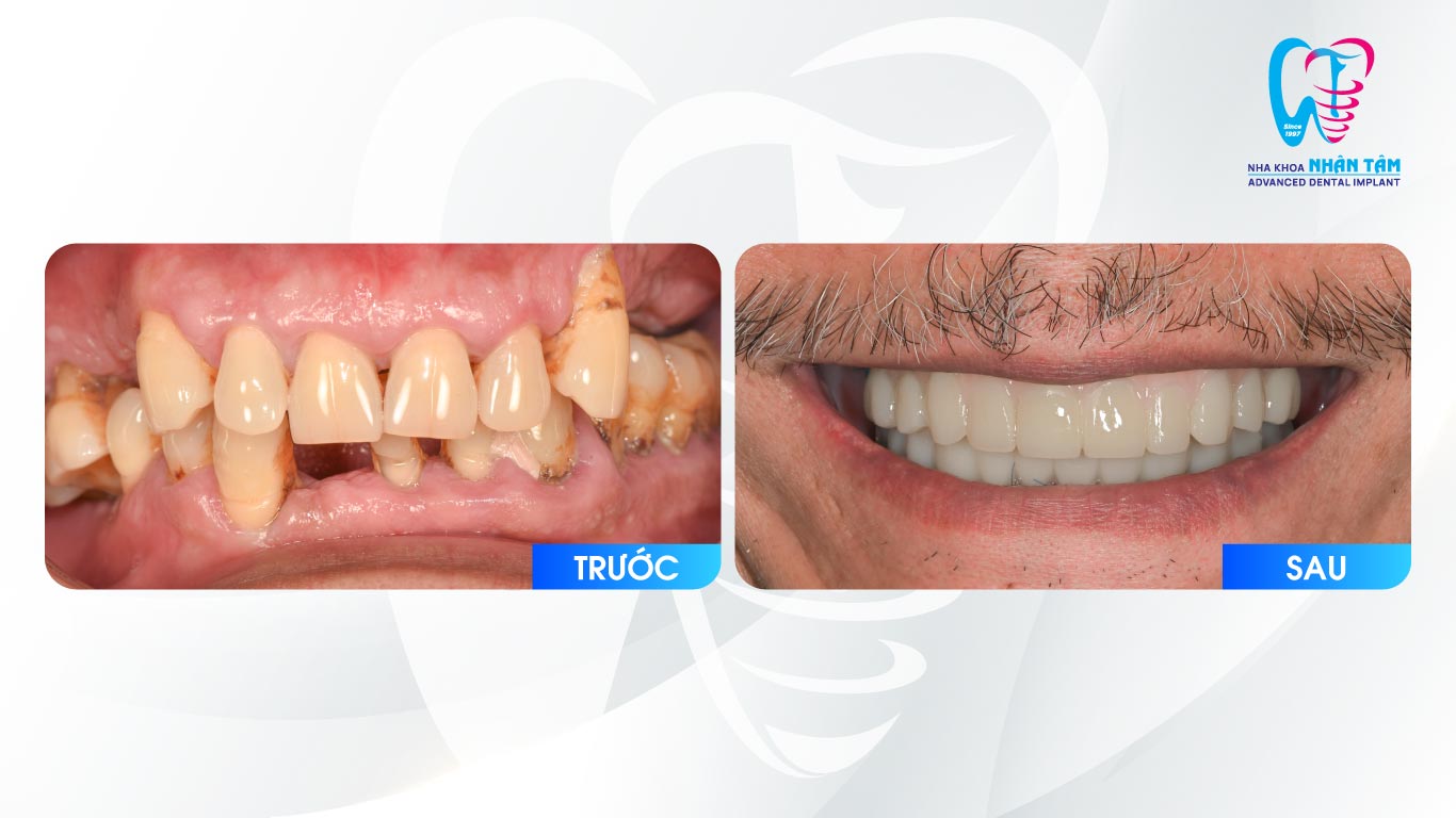 Khách hàng có răng ăn nhai và thẩm mỹ ngay trong ngày