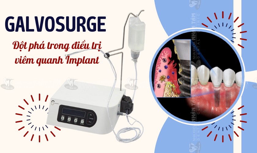GalvoSurge: Đột phá trong điều trị viêm quanh Implant