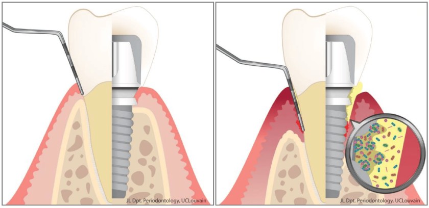 Viêm quanh Implant gây nên nhiều biến chứng nguy hiểm