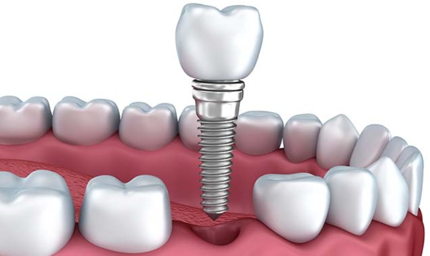 Lựa chọn loại trụ Implant không phù hợp cũng là nguyên nhân gây viêm quanh Implant