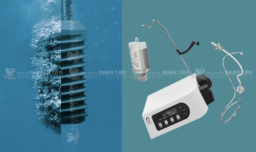 GalvoSurge giúp làm sạch và khử nhiễm bề mặt Implant chỉ trong 2 phút thực hiện